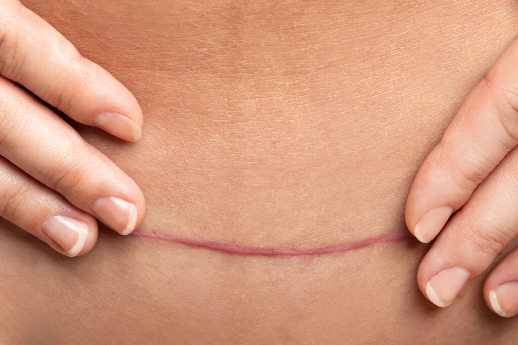 https://www.rocktape.ca/wp-content/uploads/2023/07/Scar-after-C-Section-surgery-on-female-belly-1332135279_1258x838-1024x683-1.jpg